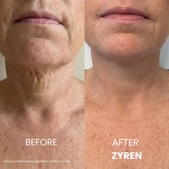 Zyren® Tighten & Lift Neck Cream